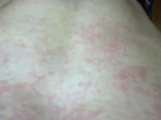 全身起红斑,麻烦指点一下.