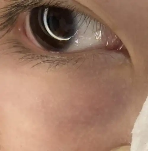 就是这个 是毛周角化还是很小的脂肪粒还是其他什么东西?