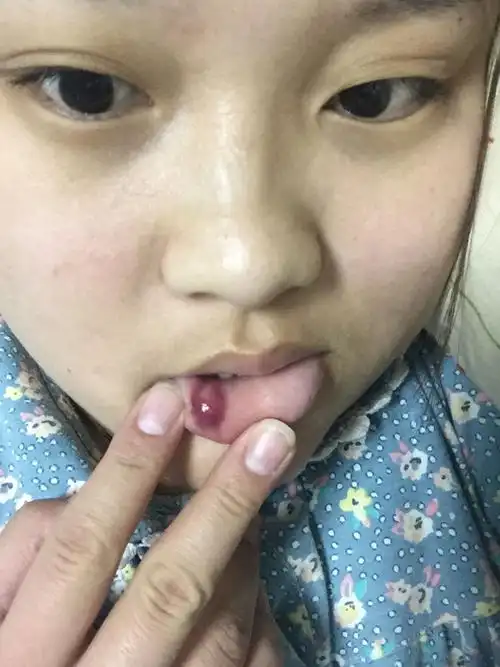 嘴唇上起了个紫血泡,不小心咬了一下,但是咬的不重,一看起了哥这么大