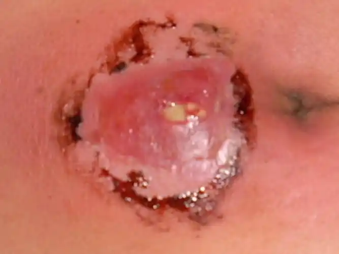 坐板疮臀部图片