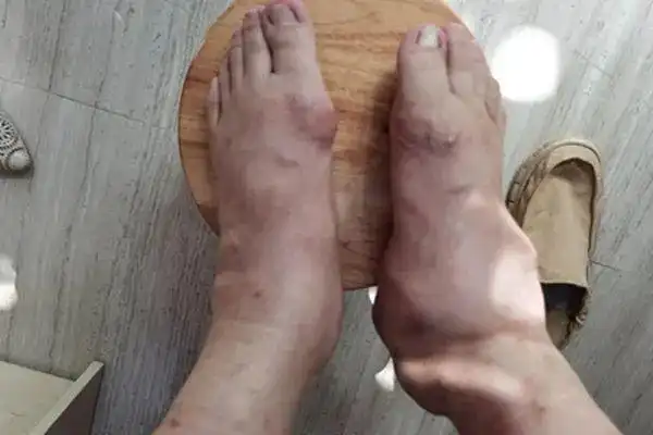 3个症状告诉你,尿酸高对人体的危害有多严重!-胡春艳-爱问医生