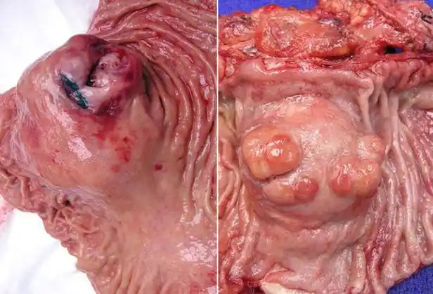 绒毛状腺瘤怎么治疗