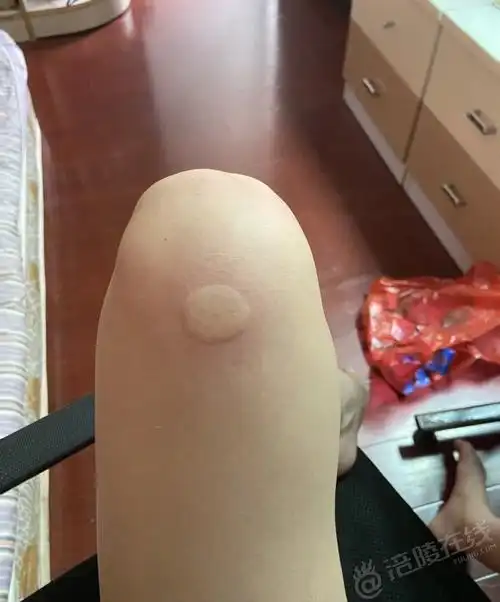 被蚊子咬了过后就有了这么大的蚊子包,真的大的离谱了!