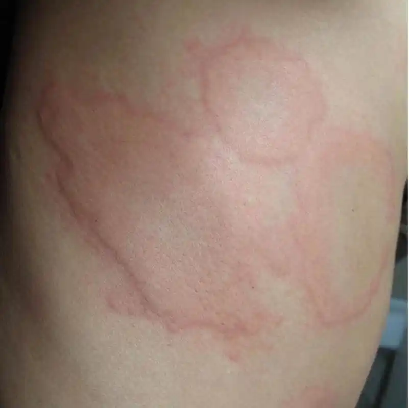 1, 急性荨麻疹的主要用药是抗组胺药(抗过敏药),对于成人来说,无