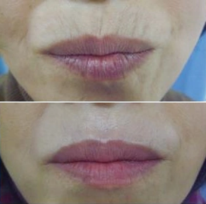 韩国陈整形外科改善嘴角纹真人案例对比