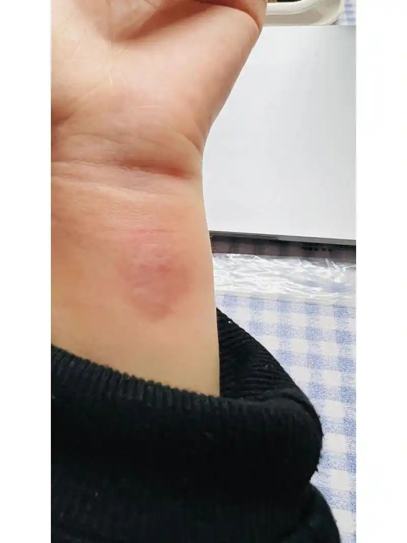 皮试结果是阳性 胸片结果正常 现在就等抽血结果咯