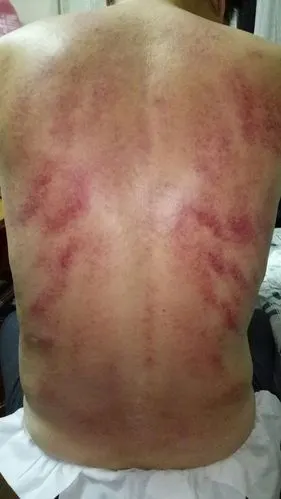 今日刮痧背部痧像,按糖尿病方案.