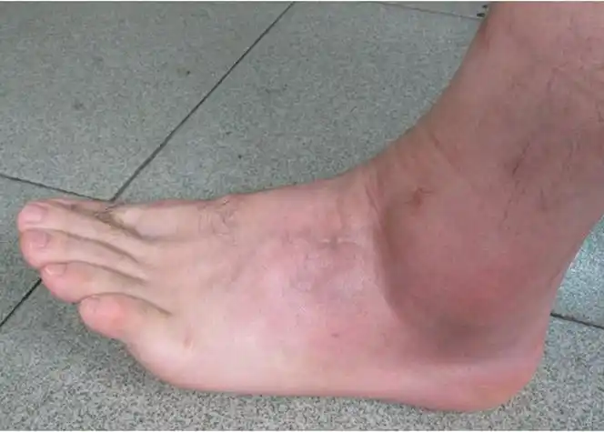 老人容易患有痛风图片