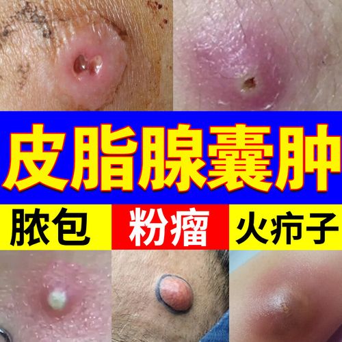 皮脂腺囊肿火疖子拔皮肤毒拔脓去除皮下皮脂腺堵塞囊肿粉瘤神器痤疮