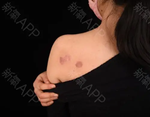 长了瘢痕疙瘩不仅仅是皮肤上的疼痛难忍,更多的是心理_圈子-新氧美容