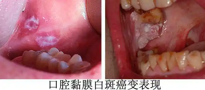 喜欢嚼槟榔和酒的人,如果口腔出现黏膜白斑就要注意了,这说明这地方的
