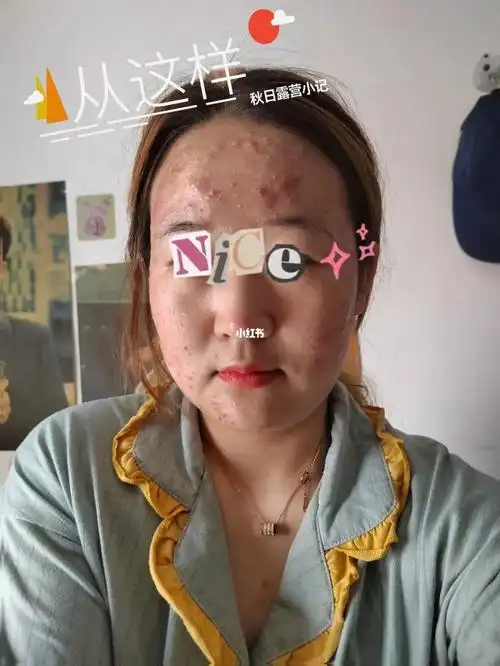 痘痘变好真的是一个过程