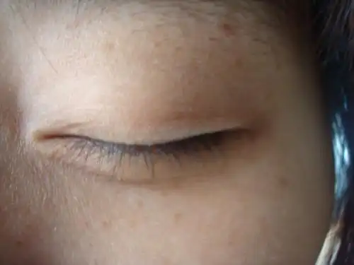 左右眼皮上张了白斑,请问要到什么医院治疗,好治疗吗?