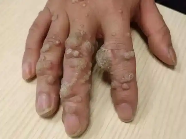 hvp感染是什么病毒:27岁男子手指长"鸡眼",确诊hpv感染,医生_佛经大全