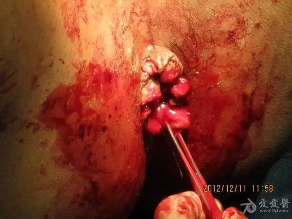 chaoyi2013-01-11 19:55:44       该患者术后1月,目前愈合后留有皮赘