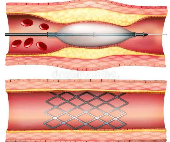 支架降价后药物球囊也降至百元支架和球囊哪个效果更好