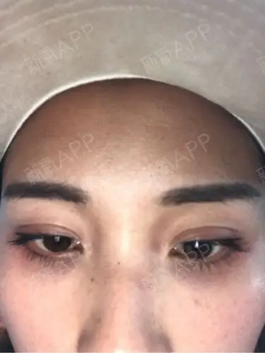 眼袋是祛掉了但眼睛却出现凹陷问题人显得更老