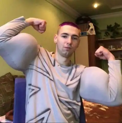 俄罗斯的西斯龙小伙面临手臂截肢现在他还好吗