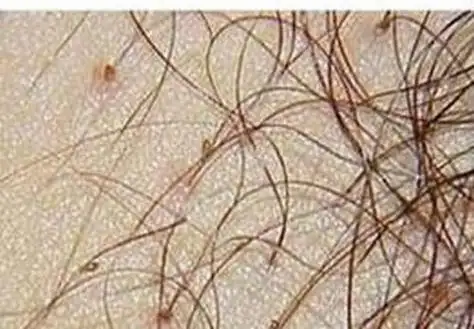 阴虱病发作的症状特点表现