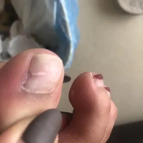 脚趾甲横向断裂了一半了等了一个月只长出来一点点还畸形了这样的指甲