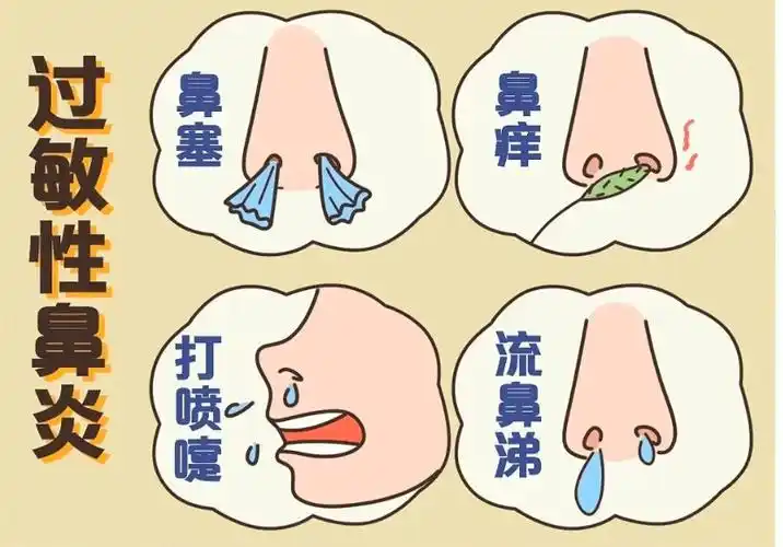 【科普】什么是儿童过敏性鼻炎?有哪些表现?_症状_孩子_患儿