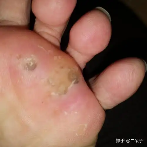 跖疣变黑是要好了吗!