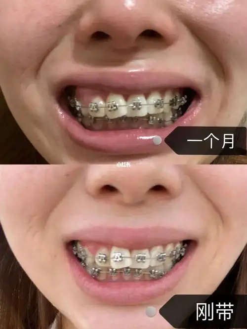 自锁牙套一个月对比
