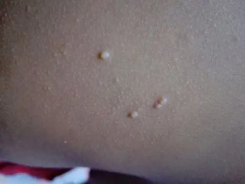 宝贝身上总是起小红疙瘩(类似小米粒大小)不痛不痒,皮肤反复复发,请问