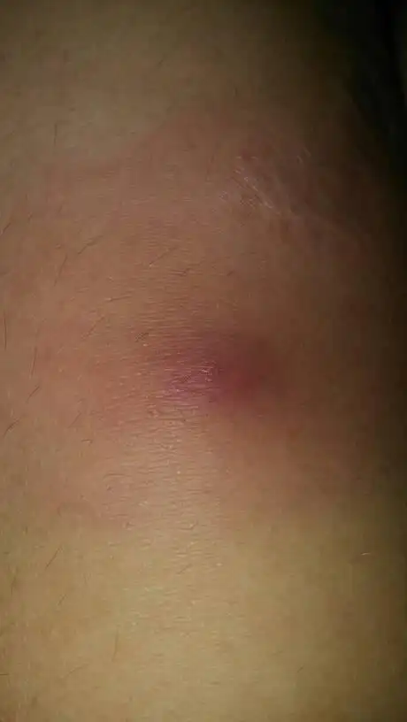 小腿上长了一个红色的肿包,很痛,周围的肉都变红了