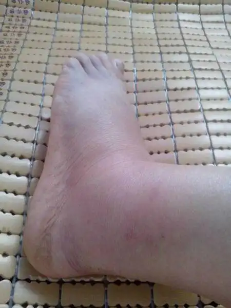 在不知不觉中脚扭伤了我该怎么办