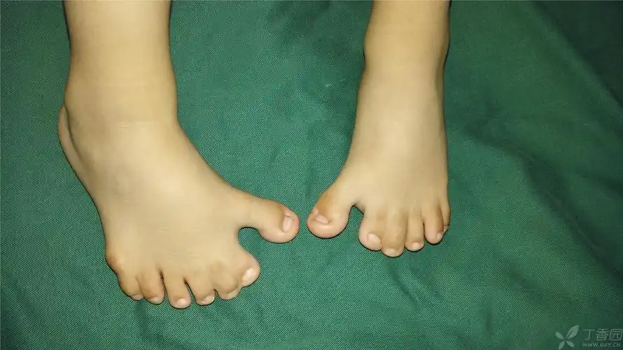 x线: 右足跖趾骨畸形,可见第6跖骨及第7趾骨存在.