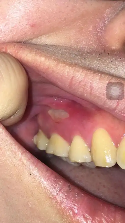 牙龈上长了个类似溃疡的东西,不疼,10几天了,有白色物质在上面,用手指