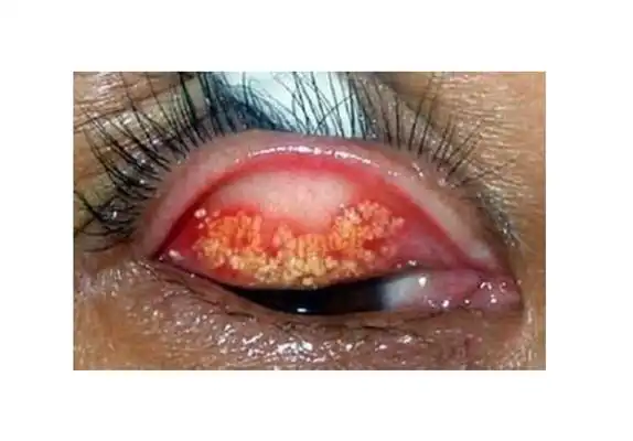 眼结石图片 (33)