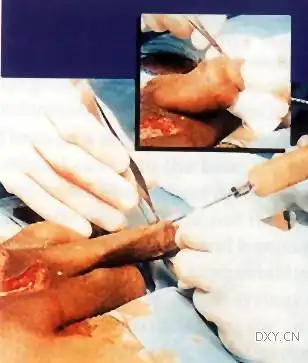 阴茎延长的方法(男性生殖延长手术需要多少钱)