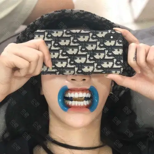 为了一口美白的牙齿我选择了om1色号的美牙贴面