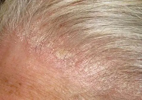 如何区分头皮屑和头皮牛皮癣银屑病真实对照图解-中华银屑病网