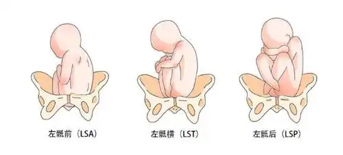 例如头先露,枕骨在骨盆左侧,朝前,则胎位为左枕前(loa),为最常见之