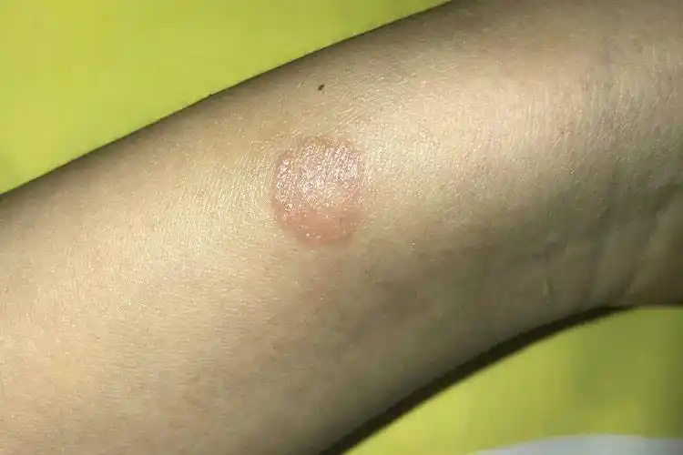 铜钱癣的症状及图片_有来医生