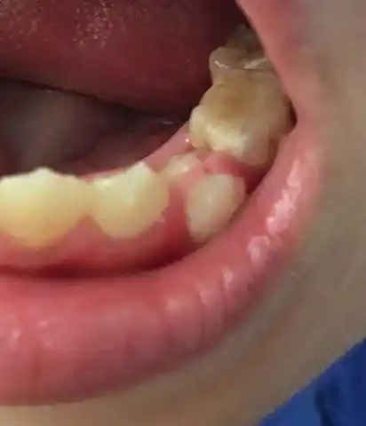 请问孩子大牙上面有条肉是怎么了会长好吗