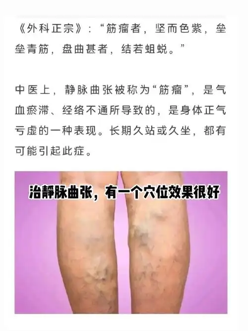 见人不如健身 #笔记灵感  #健身  #穴位养生  #静脉曲张  #小红书