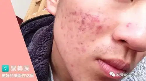 痘印痘疤不在心情无比畅快