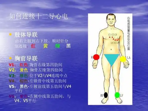 严重心肌缺血,不稳定,心绞痛,心肌梗死,12导联st段能持续心电监护,能