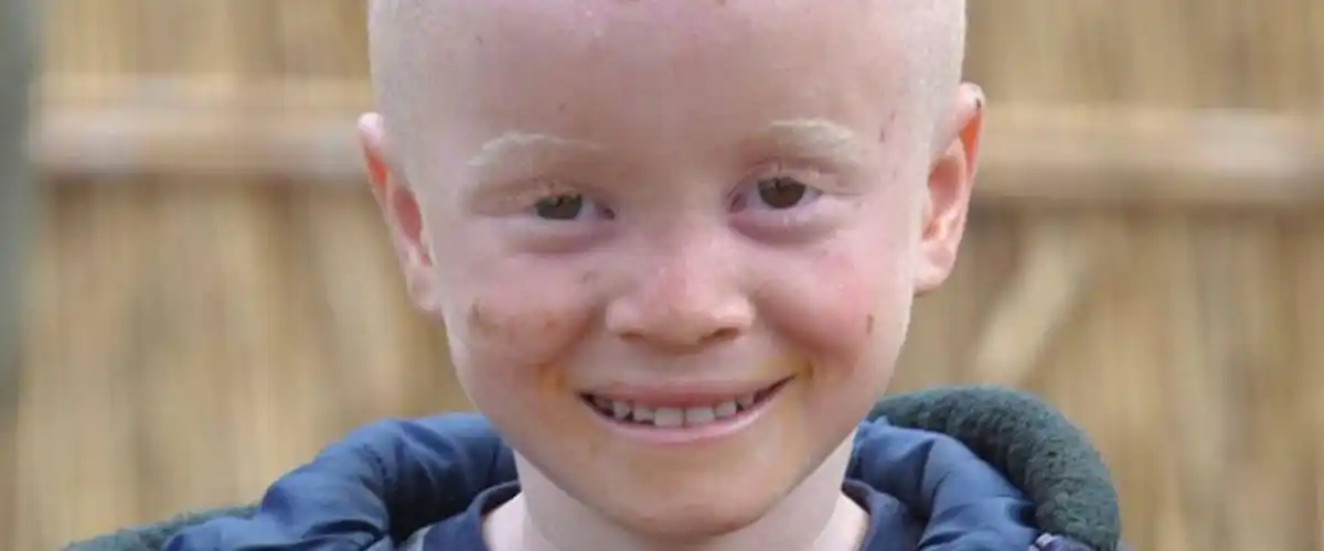 南非的一位患有白化病的儿童.莫桑比克儿基委图片/sergio fernandez