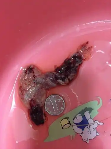 大孕周药物哪咤先兆流产好大夫在线哥白尼