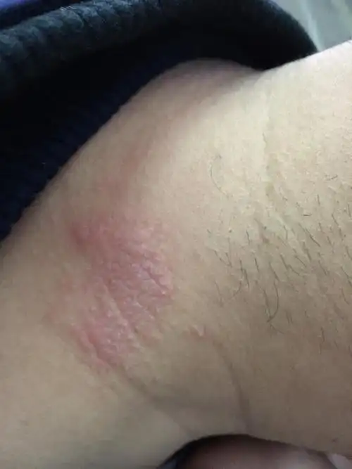 脖子后面红色像湿疹似的,碰到有点疼,不太痒,谁知道?