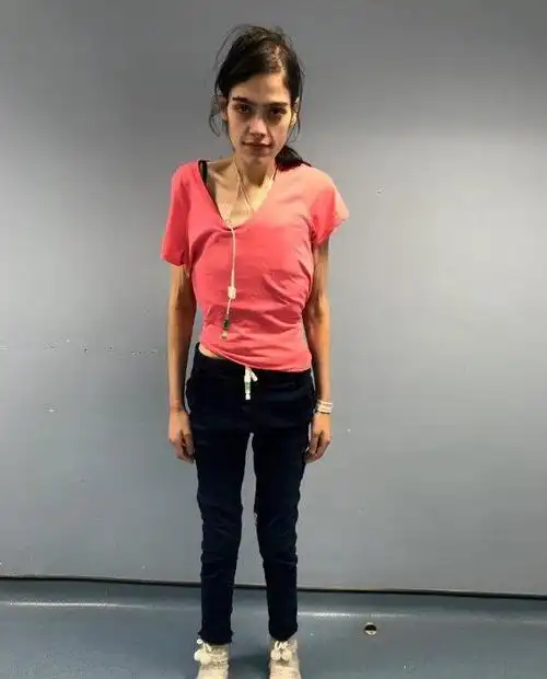 女子身患怪病,从200多斤暴瘦成皮包骨头,看着还有点吓人