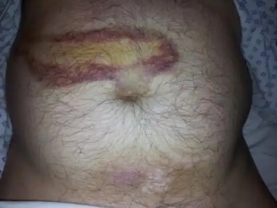 cullen征并非总提示急性胰腺炎