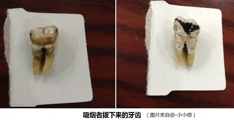 警惕:吸烟对口腔健康的危害! - 口腔科普-福建省口腔医学会