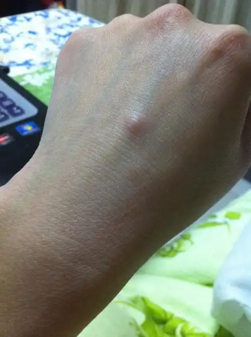 今天下午手背上突然起了一个个大小黄豆粒大