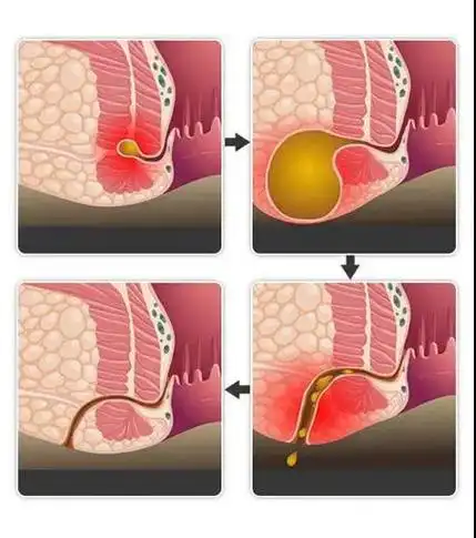 手术越早,效果越好肛瘘不能自行愈合,久而久之,不断感染排脓,就会形成